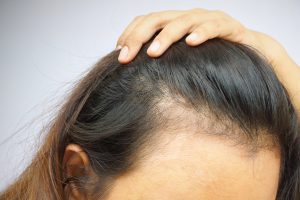 Causes of hair loss in females