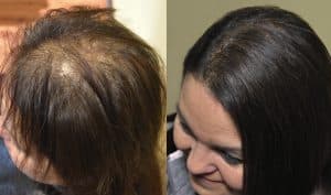 Alopecia_and_hair_extensions